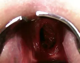 kinkyniky podwójny anal fisting wypadanie xo speculum gapić